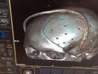 Уникальную операцию по установке индивидуального импланта в череп провели в Ставрополе
