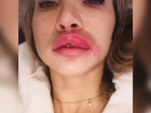 Псевдо-косметолог, «уколы красоты» которой изуродовали ставропольчанку, осуждена на 4 года