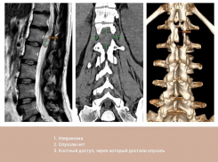 Опухоль из позвоночника через крошечный разрез удалили пациентке нейрохирурги Пятигорска