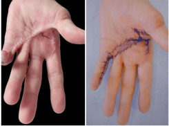 Хирурги Пятигорска вернули мужчине подвижность руки после страшной травмы на работе