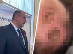 После скандала с пролежнями у пациентки минздрав нашел ряд проблем в Георгиевской районной больнице