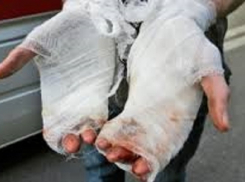 Ожоги тела получил житель Ставрополья из-за пожара в частном доме