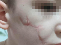 Мама пострадавшего от укуса бездомной собаки из Ставрополья взывает к помощи президента Путина 