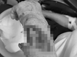 Порвала руку: 83-летняя ставропольчанка попала в больницу из-за скользкой лестницы 