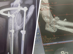 Ставропольские врачи собрали мужчину по частям после падения с высоты 6 метров