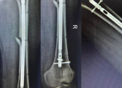 Чудо в Ставрополе: 55-летнего мужчину вернули к жизни после падения с семиметровой высоты