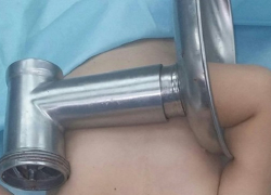 Рука двухлетнего малыша застряла в мясорубке