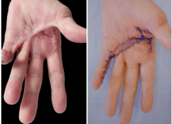 Хирурги Пятигорска вернули мужчине подвижность руки после страшной травмы на работе