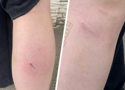 Собака искусала девочку в ставропольском поселке