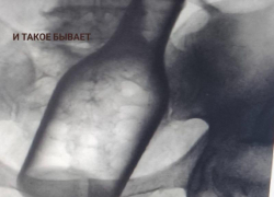 Монета, проволока, бутылка: что извлекали из ставропольских пациентов в 2025 году