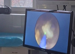 Ребенок мучился от боли, но скальпель не понадобился: врачи в Ессентуках раздробили камень лазером