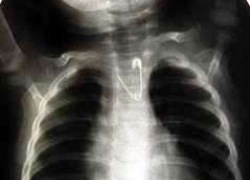 Годовалая девочка проглотила булавку и скончалась в больнице Ставрополя