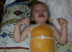 Двухлетняя девочка получила ожоги в детском саду Буденновска