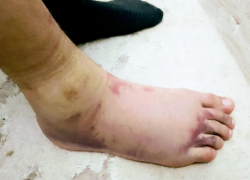 Директор получил наказание за  травмированного на уроке физкультуры подростка на Ставрополье