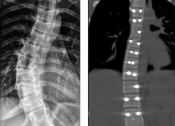Ставропольские нейрохирурги провели сложную операцию по коррекции сколиоза