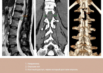 Опухоль из позвоночника через крошечный разрез удалили пациентке нейрохирурги Пятигорска