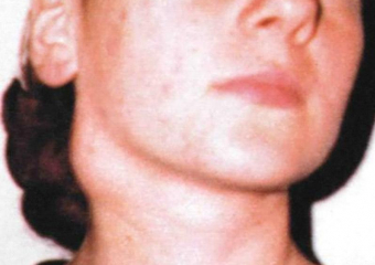 Еще один случай заражения туляремией подтвердили на Ставрополье 