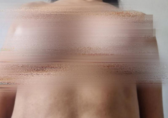 Пациентка судится с клиникой в Ставрополе после неудачной подтяжки груди