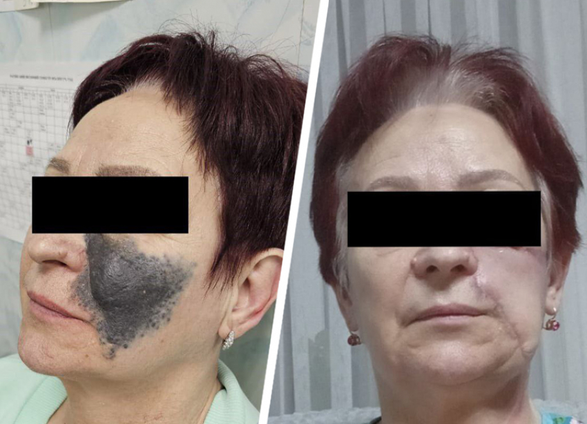 Гигантскую черную родинку на лице пенсионерки удалил хирург в Ставрополе