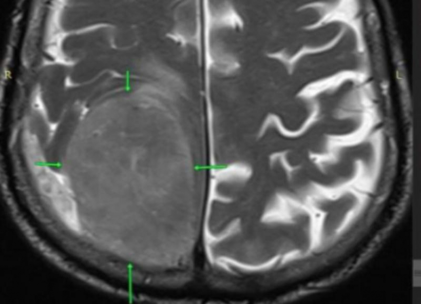В голове 85-летнего пенсионера в Пятигорске обнаружили опухоль размером с лимон