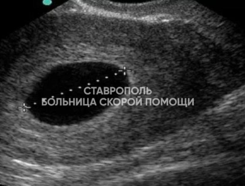 Контрацептивы не сработали: реальная история пациентки из Ставрополя