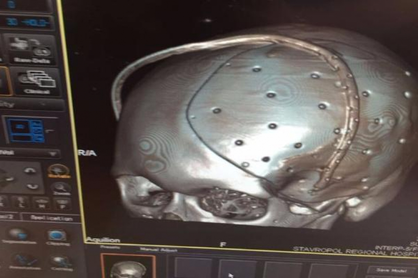 Уникальную операцию по установке индивидуального импланта в череп провели в Ставрополе