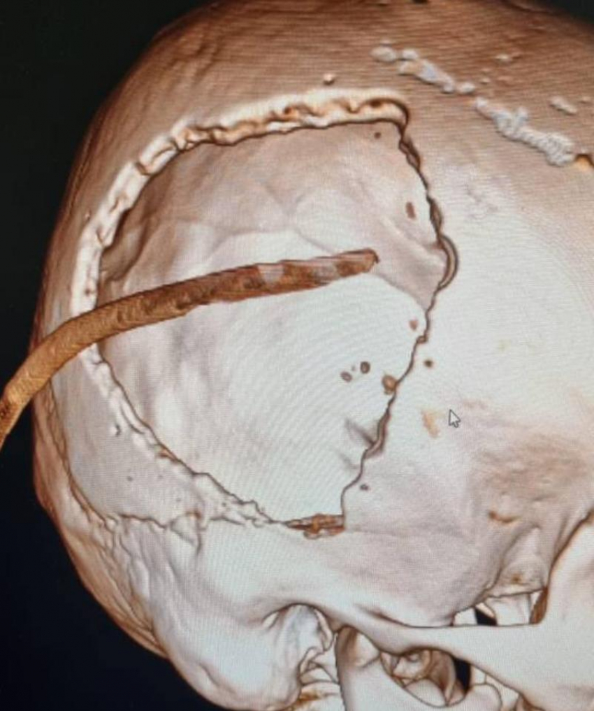 Не разбудили утром: история 30-летнего парня, выжившего после падения и сложнейшей операции на мозге в Ессентуках