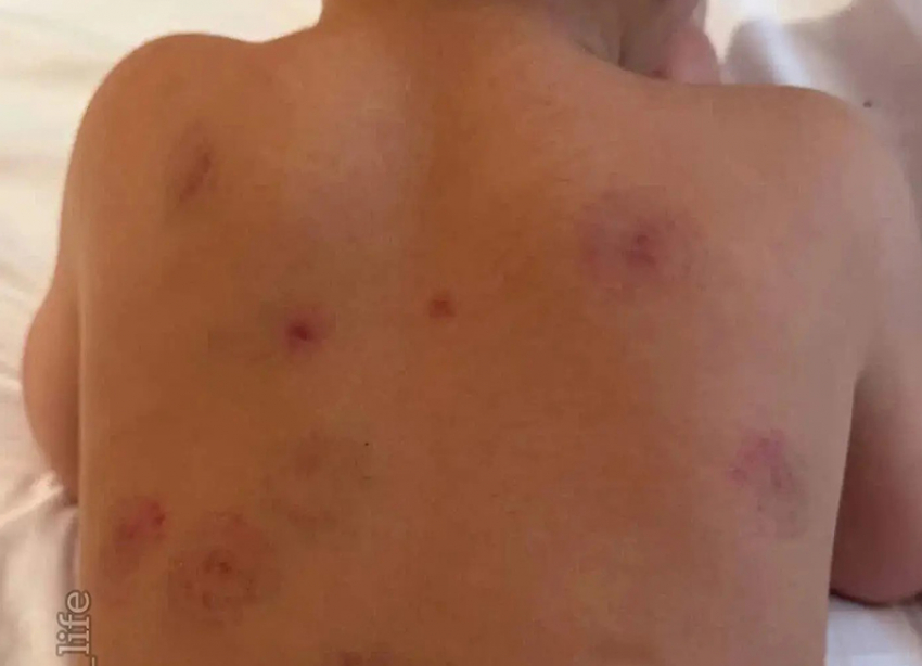 Сразу 16 укусов на теле ребенка насчитала мама после его посещения детсада в Минводах