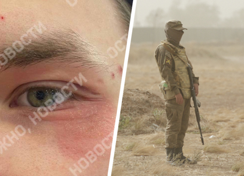 «Тут и с болезнями похуже служат»: в военную часть под Ставрополем попал парень с тяжелым дерматитом