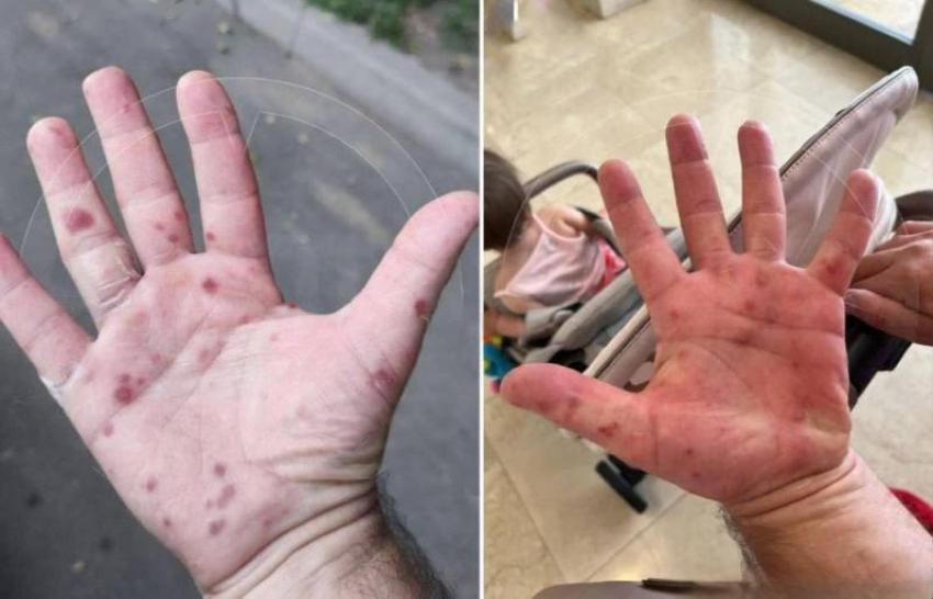 Роспотребнадзор скрывает от жителей Ставрополья заболеваемость вирусом Коксаки