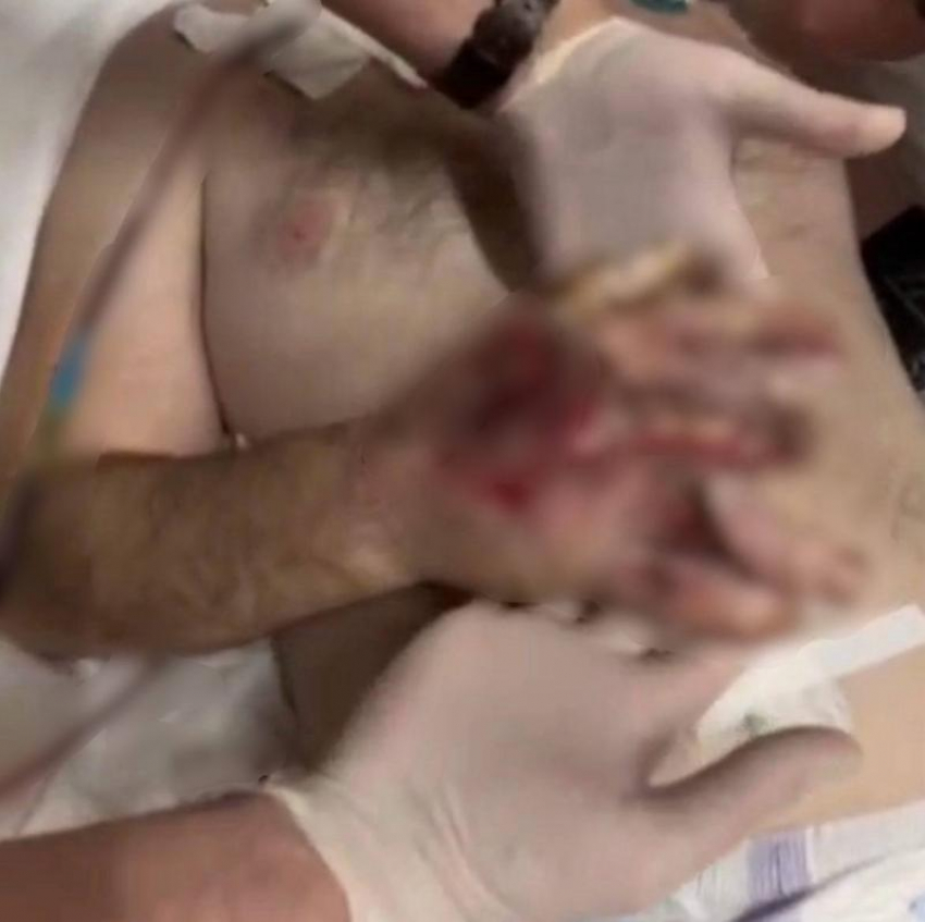 Разорванную руку после ДТП спасли мужчине врачи из Ставрополя 