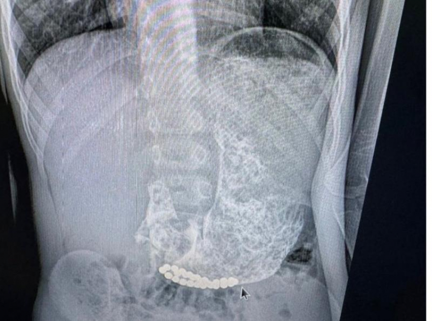 Три ребенка на Ставрополье проглотили металлические магнитные шарики