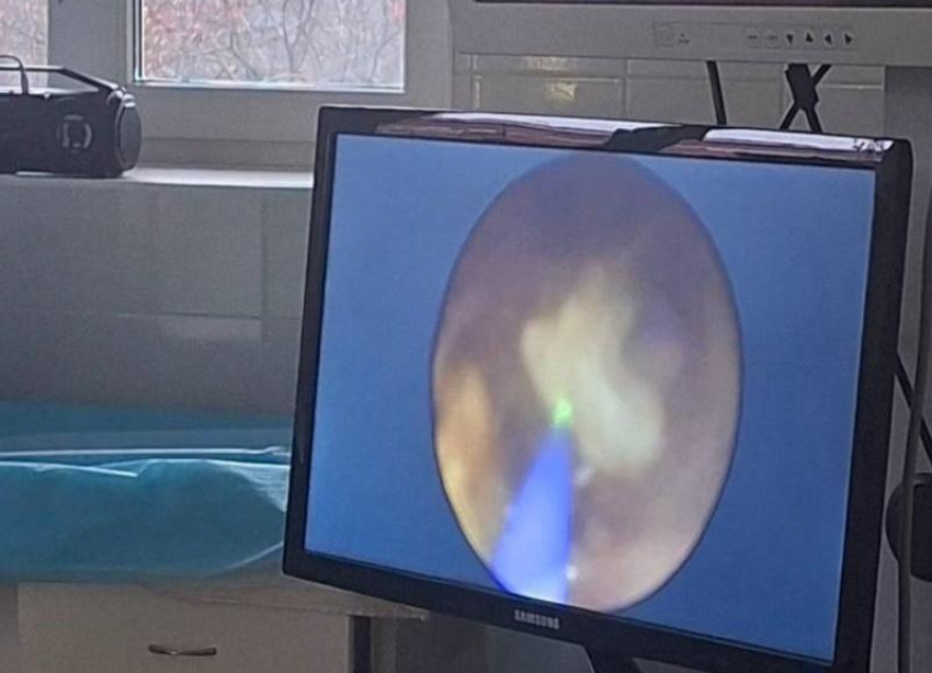 Ребенок мучился от боли, но скальпель не понадобился: врачи в Ессентуках раздробили камень лазером