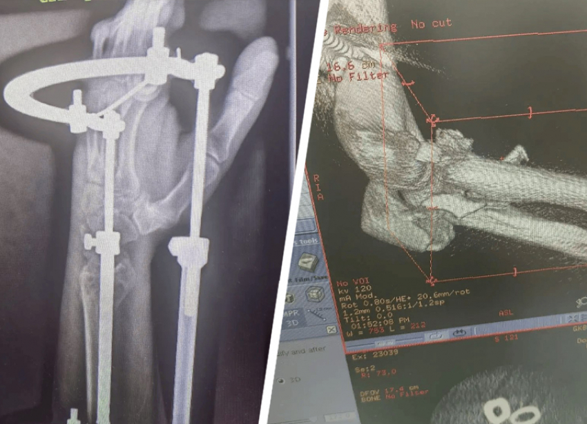 Ставропольские врачи собрали мужчину по частям после падения с высоты 6 метров