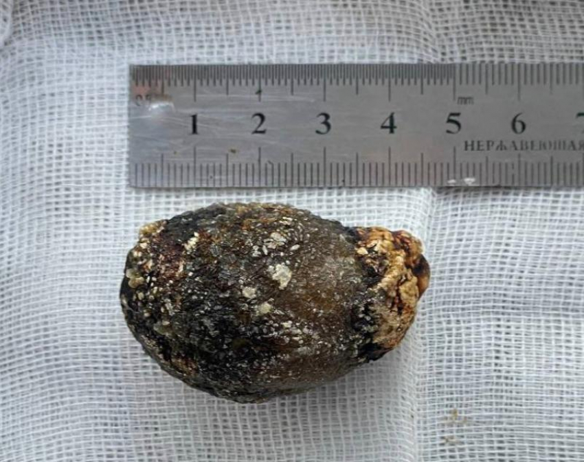 Огромный булыжник нашли пятигорские хирурги в желчном пузыре пациентки