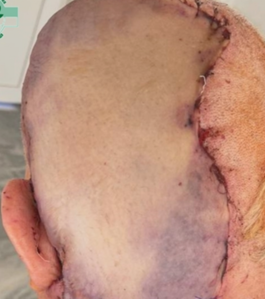 Ставропольские хирурги впервые в СКФО удалили гигантскую ангиому кожи головы 
