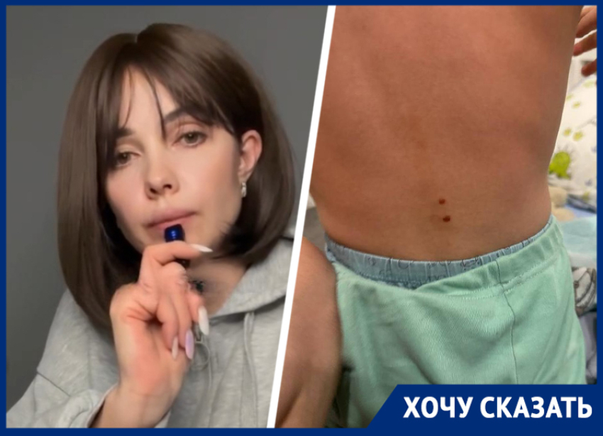 Ожоги на спине после посещения детсада: мать на Ставрополье пытается доказать факт издевательств над ребенком